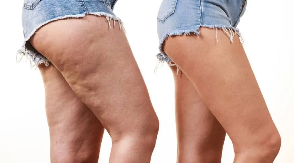 Lipedema releif