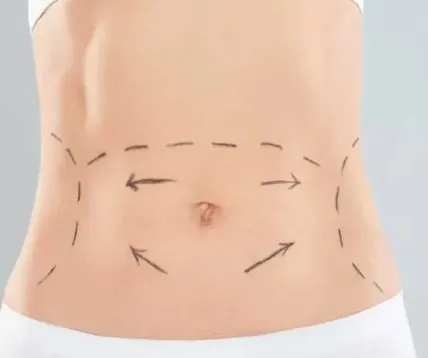 How Many Lymphatic Drainage Sessions Do You Need After Surgery