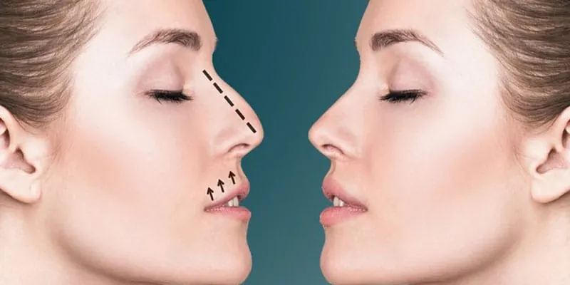 Side-by-side profiles of a woman's face show a nose enhancement process with dotted lines and arrows. Background is teal.